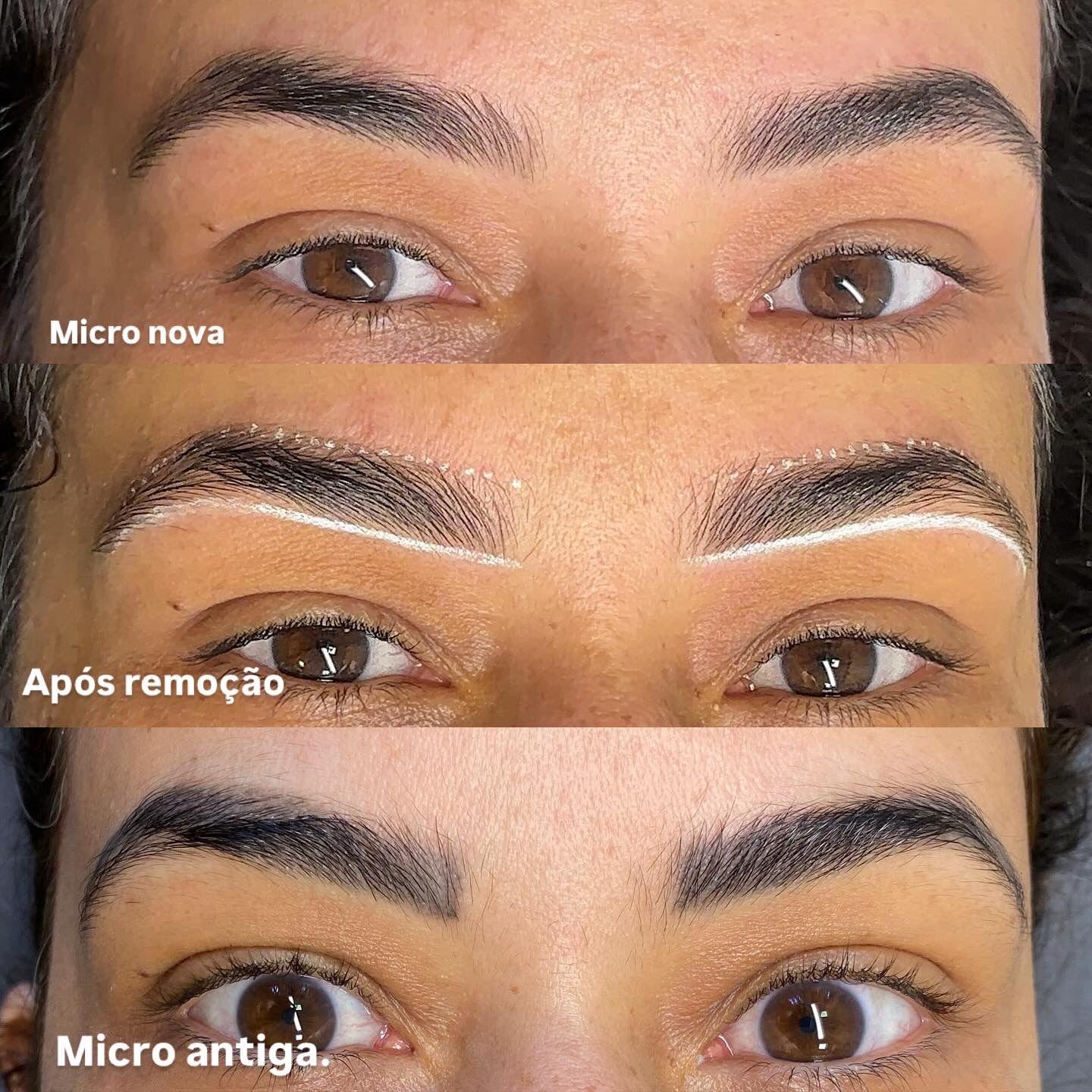 Etapas de remoção a laser