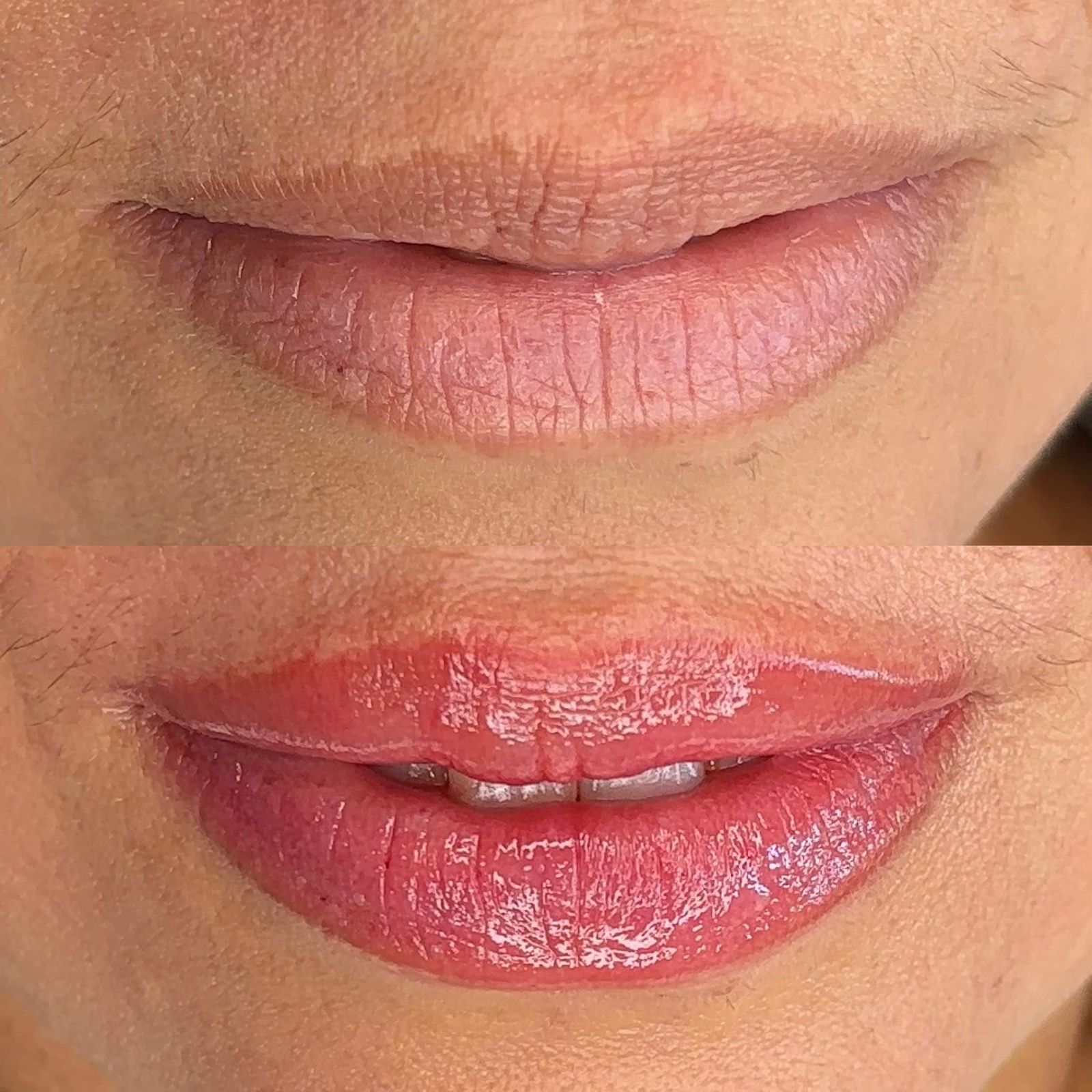 Antes e depois labial